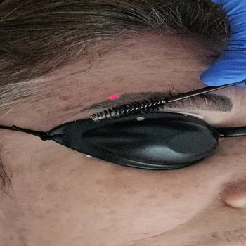 Laser Tattoo Removal South Miami
